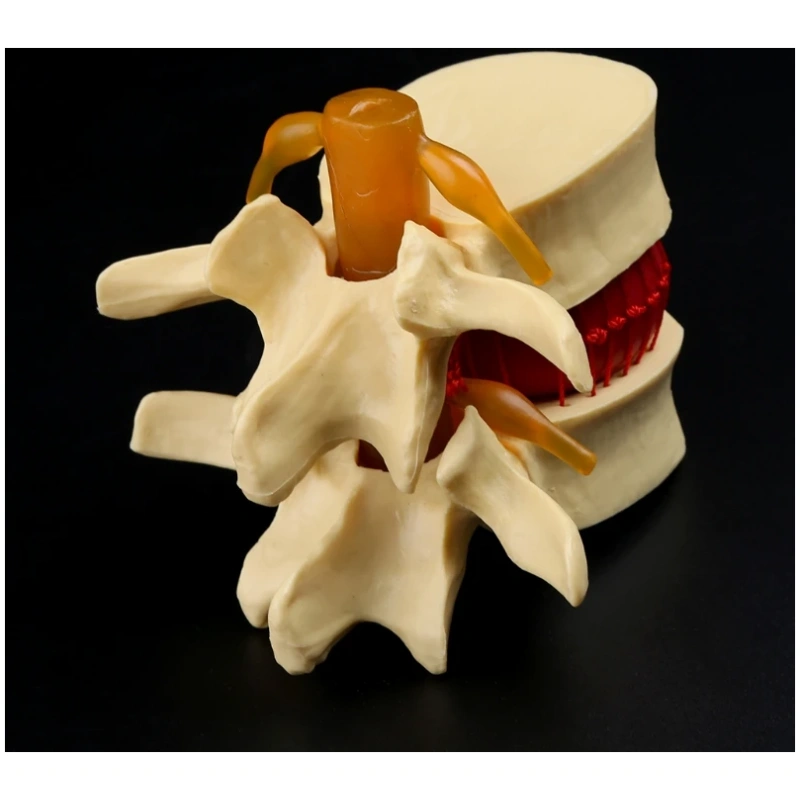 Medical props model Anatomical Spine Lumbar Disc Herniation Anatomy Medical Teaching Tool - Image 3